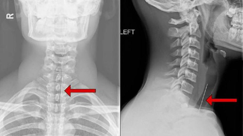 Những người chụp X-quang vùng cổ có nguy cơ cao bị u tuyến giáp